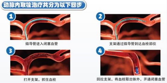 最新取栓术,最新取栓术，医疗领域的革新之光