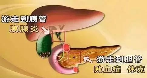 温馨日常中的治疗奇迹，肝内胆管结石最新药物探索与故事分享