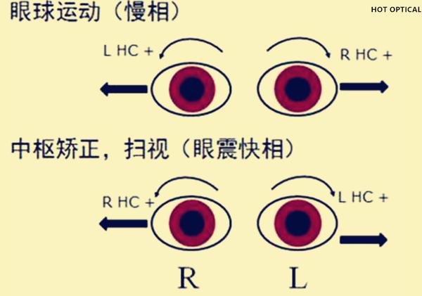 眼球震颤最新治疗方法，自信之光重塑视界新篇章